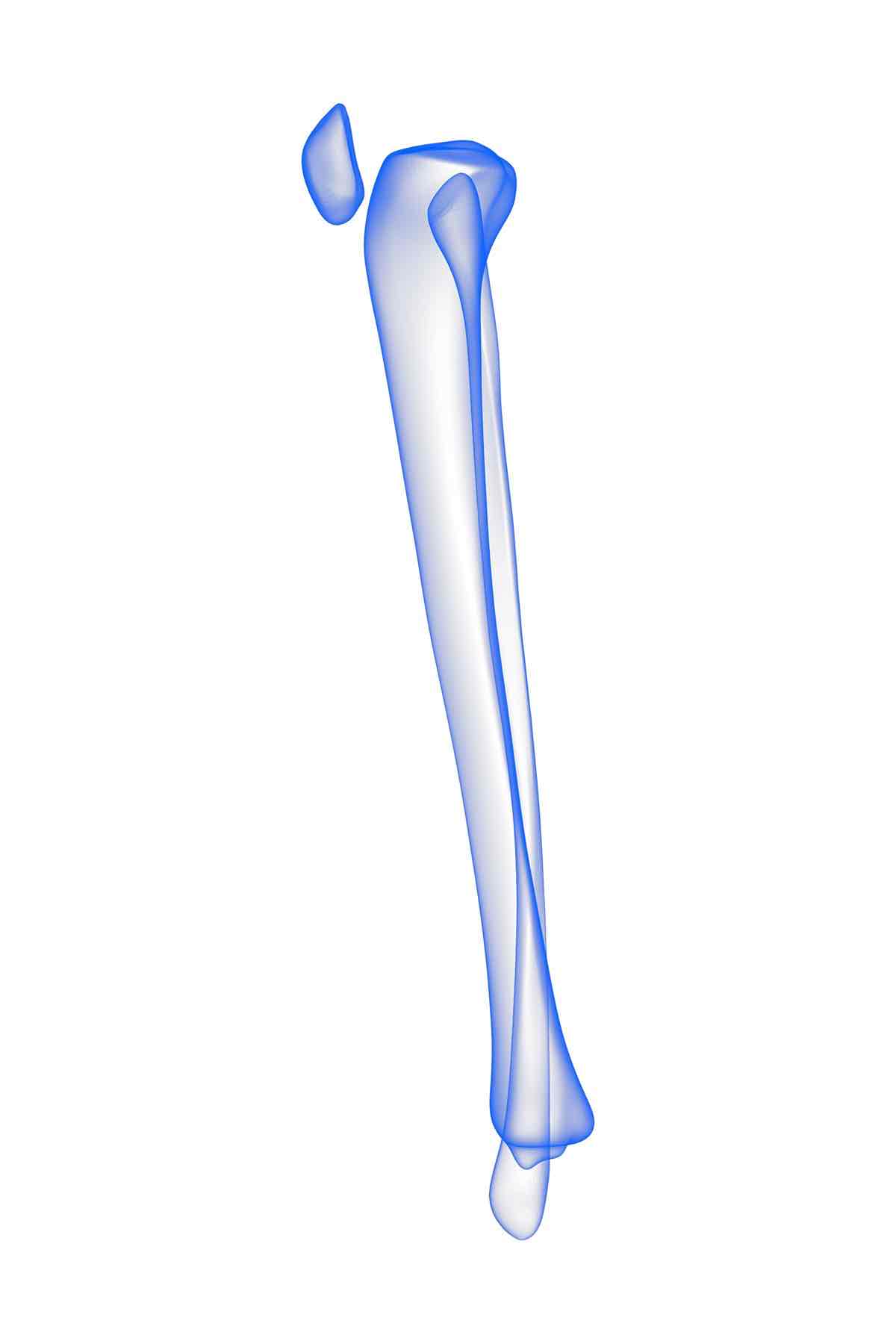 High tibial osteotomy (HTO) in Reading — Mr Sam Nahas Graphical representation of the proximal tibia used for high tibial osteotomy (HTO).