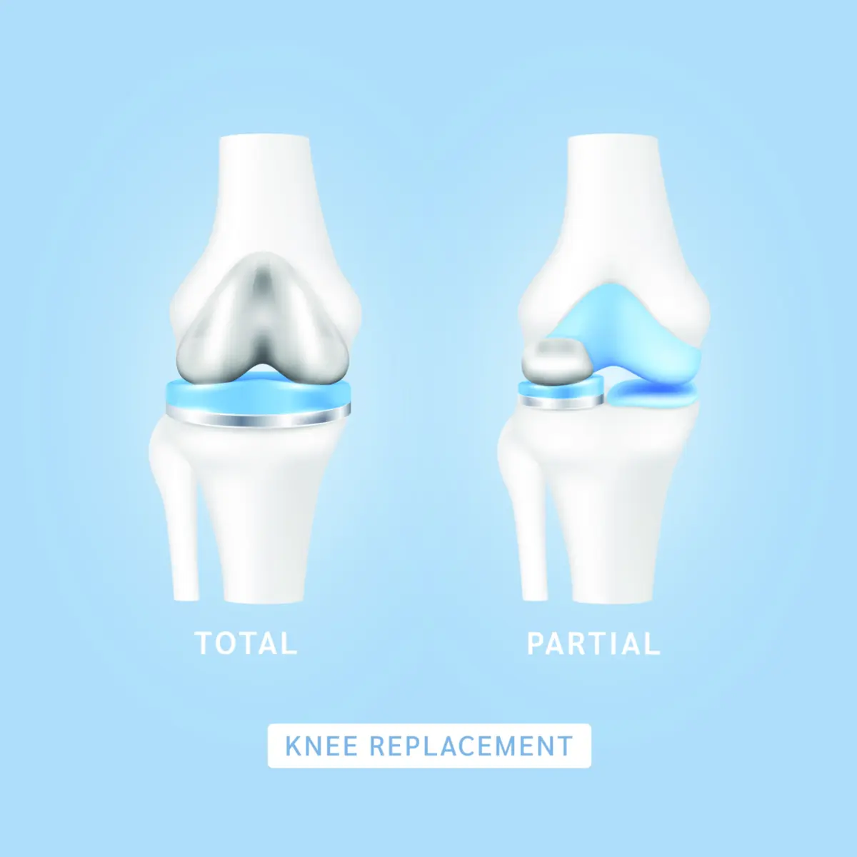 Side-by-side knee implant models showing unicompartmental (UKR) and total knee replacement (TKR)