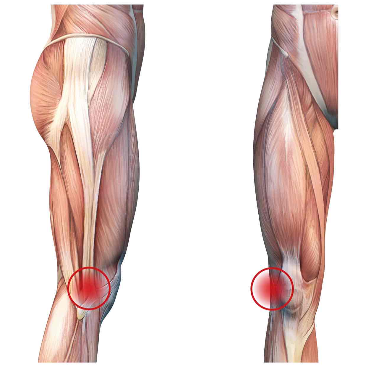 Diagram illustrating the iliotibial band and the area of surgery.