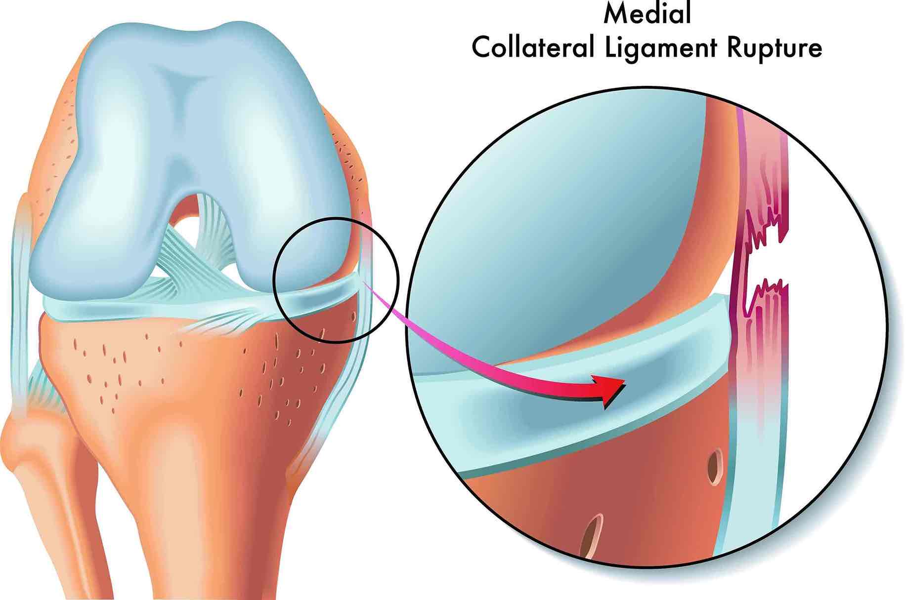 Anatomical diagram highlighting the medial collateral ligament (MCL) on the inner knee.