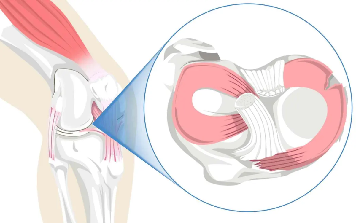 Meniscal root repair in Reading — Mr Sam Nahas Labeled illustration of the meniscus