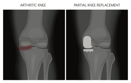 Before-and-after knee X-rays showing medial compartment osteoarthritis and postoperative unicompartmental knee implant