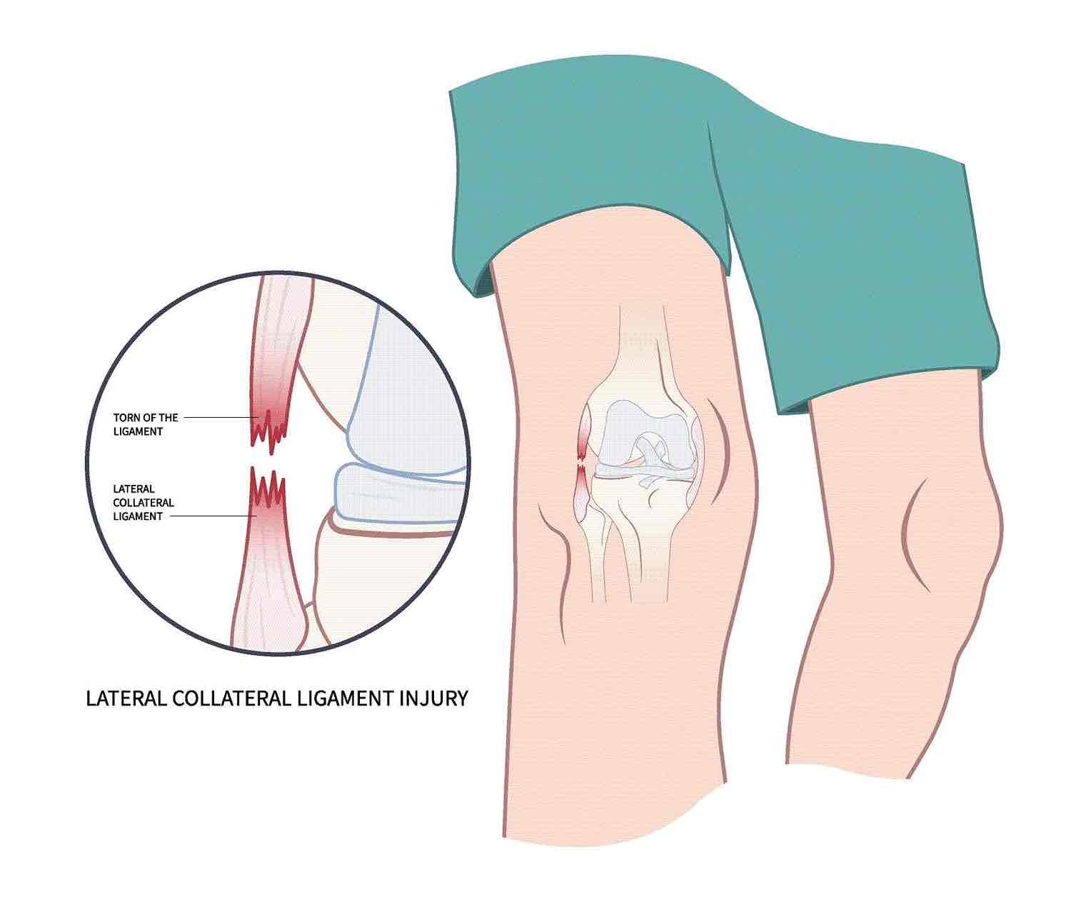 Posterolateral corner (PLC) & LCL in Reading — Mr Sam Nahas Anatomical diagram highlighting the lateral collateral ligament (LCL) within the posterolateral corner of the knee.